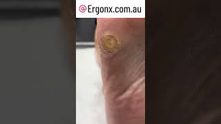 Huge satisfying corn and callus removal by podiatrist These are very painful to walk on [upl. by Walcoff]