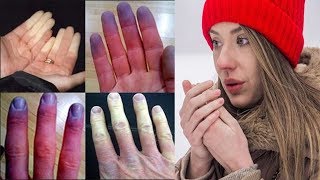 Raynauds Disease  phenomenon Tips and Proven Natural Cures [upl. by Tebasile917]