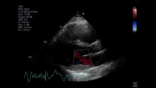 Fatal Giant Cell Myocarditis [upl. by Netti]