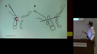 quotChiari Malformations and Chiari 15quot  Robert Kellogg MD [upl. by Sussna]