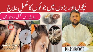 Sar Ki Juen Khatam Karne Ka Tarika  Head Lice Removal  Lice In Hair Symptoms Causes And Treatment [upl. by Opportuna]