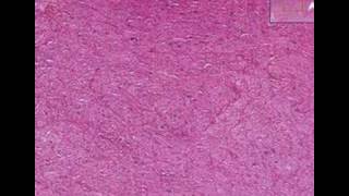 Histopathology NerveGanglioneuroma [upl. by Engle]