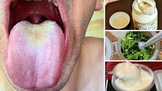 10 Remedios Caseros Para Tratar La Candidiasis Oral [upl. by Aihsekal985]