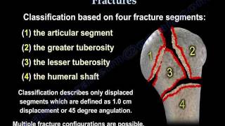 Proximal Humerus Fractures classification  Everything You Need To Know  Dr Nabil Ebraheim [upl. by Ihcego]