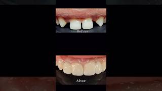 Congenitally missing maxillary lateral incisors rehabilitated using Emax crown cosmeticdentistry [upl. by Snell]