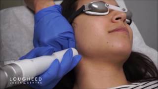 Laser Hair Removal With the Softlight Laser [upl. by Diannne632]