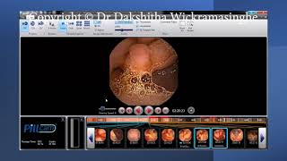 How to perform a capsule endoscopy Updated [upl. by Sarat]