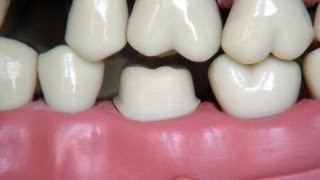 Full metal crown preparation  for dental students [upl. by Nageek286]