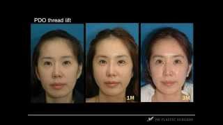 Korean Thread Lift amp Nose Filler Before amp After Surgery Pictures From JW Plastic Surgery [upl. by Arahs]