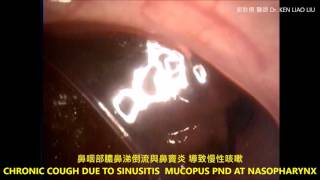 慢性咳嗽的主因之一 鼻咽炎膿鼻涕倒流與鼻竇炎 CHRONIC COUGH  SINUSITIS amp NASOPHARYNX PND [upl. by Notrom628]