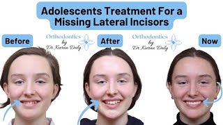 Substitution of Missing Lateral Incisors in Adolescent Patient [upl. by O'Conner]