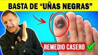 👣 Cómo CURAR una UÑA NEGRA del PIE  hongos en uñas ✅ remedio casero que FUNCIONA [upl. by Ardet]