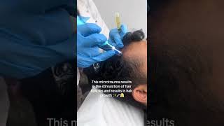 PRP Treatment for hair loss prptreatment londonontario [upl. by Akiehs303]