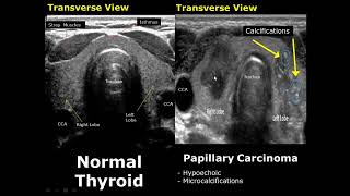 Thyroid Ultrasound Normal Vs Abnormal Image Appearances Comparison  Thyroid Pathologies USG [upl. by Alyehs]