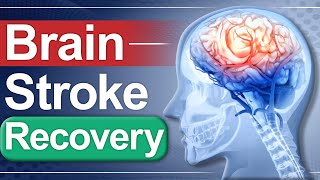 Brain Stroke Recovery  Paralysis Causes amp Treatment  Dr Puru Dhawan [upl. by Sheila]