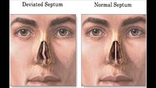 Does a Septoplasty Surgery Affect Your Singing Voice [upl. by Ahseid]