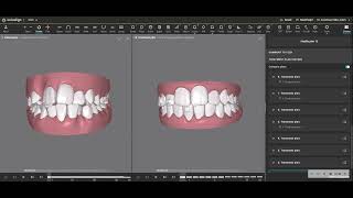 A Treatment Simulation that Avoided Extraction of Four Premolars for Orthodontic Treatment [upl. by Dewie]