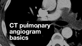 Pulmonary CT Angiogram Basics [upl. by Grim]