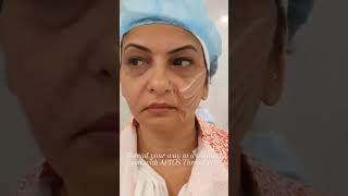 Say goodbye to sagging skin Aptos Thread Lift is a noninvasive minimally invasive solution [upl. by Ynad640]