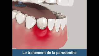 Le traitement de la Parodontite  Esthetic Hair Smile [upl. by Giffer]