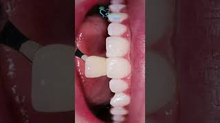 Dental Bleaching Before and After [upl. by Llevel]