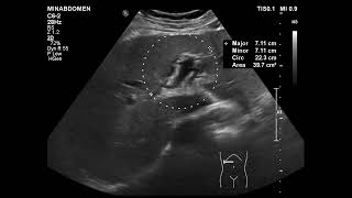 acute cholecystitis amp periportal halo [upl. by Aital]