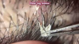 Big Cystic Acne Blackheads Extraction Blackheads amp Milia Whiteheads Removal Pimple Popping [upl. by Nalek44]