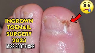 Ingrown Toenail Surgery 2023  Cutting Out Nail  Full Treatment By Miss Foot Fixer [upl. by Kcirderfla109]