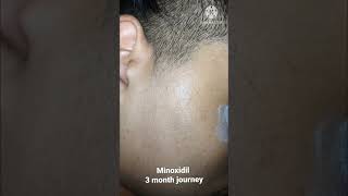 Minoxidil 3 months journey Tugain 5 solution minoxidil reselt [upl. by Rim509]