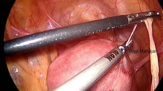 STEP 1  BOWEL AND OMENTAL ADHESIOLYSIS [upl. by Aholla]