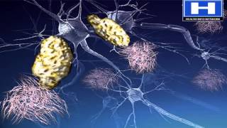 Alzheimers disease Pathophysiology Symptoms Causes and Treatment  3D animation [upl. by Liggett]