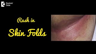 INTERTRIGO  Rash in Skin Folds  Causes Symptoms and Treatment  DrNischal K C  Doctors Circle [upl. by Sexton]