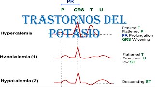 TRASTORNOS DEL POTASIO HIPOKALEMIA  HIPERKALEMIA  TRATAMIENTO Y MANEJO [upl. by Eidoc]