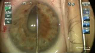 Nanophthalmos Small Pupil Phaco with Healon5 and Anterior Iridozonulohyaloidectomy IZHV Ike Ahmed [upl. by Gluck]