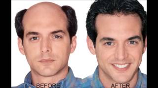 Onion Juice Cure Hair Loss And Promote Hair Regrowth  How To Regrow Hair [upl. by Votaw]