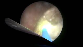 Holmium laser lithotripsy of bladder stone [upl. by Atirb]