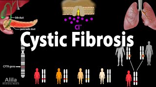 Cystic Fibrosis Pathophysiology Genetics Symptoms Diagnosis and Treatments Animation [upl. by Licec151]