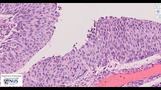 Renal pelvis Invasive urothelial carcinoma Microscopy  Talking slide [upl. by Subocaj]