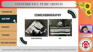 Constrictive pericarditis [upl. by Alasdair207]