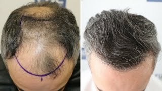 FUE HAIR TRANSPLANT 3700 Grafts in NW Class V by Dr Juan Couto  FUEXPERT CLINIC Madrid Spain [upl. by Lovett504]