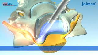 CESSYS®  Cervical Endoscopic Surgery System [upl. by Ahsikit]