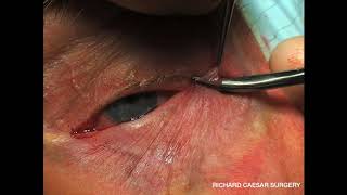 Lower Eyelid Ectropion  A Practical Approach [upl. by Yaned]