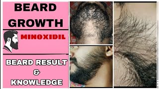 BEARD GROWTH  BEARD RESULT AND KNOWLEDGE [upl. by Madelle]