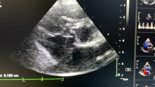 Isolated Gerbode defect [upl. by Manvel]