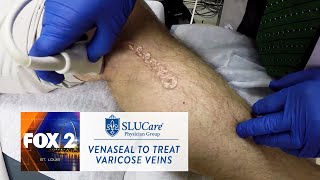 How The New VenaSeal Varicose Vein Treatment Works  SLUCare Health Watch [upl. by Sears]