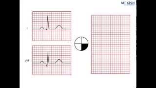 Working out the QRS axis on an ECG [upl. by Francene]