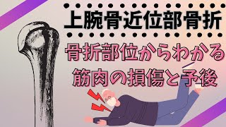 上腕骨近位部骨折 骨折部位からわかる筋肉の損傷と予後 [upl. by Luapnoj703]