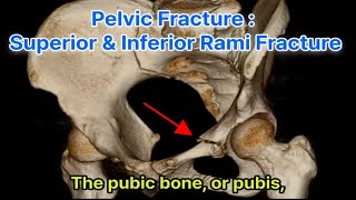 Pelvic Fracture  Superior and Inferior Rami Fracture 골반 골절 치골 상하지 골절의 이해 [upl. by Nyltac]