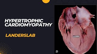 Hypertrophic Cardiomyopathy [upl. by Crowns]