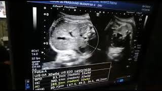 OBS scan at 33 weeks pregnant finding Narrow fetal thorax  In Urdu amp Hindi [upl. by Nitsirt]